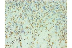 Immunohistochemistry of paraffin-embedded human breast cancer using ABIN7174129 at dilution of 1:100 (TDP1 antibody  (AA 1-260))