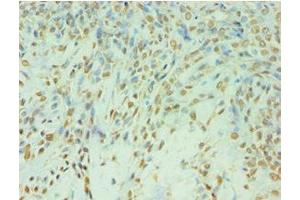 Immunohistochemistry of paraffin-embedded human breast cancer using ABIN7174129 at dilution of 1:100