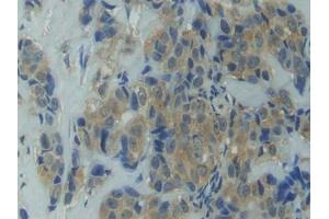 DAB staining on IHC-P; Samples: Human Breast cancer Tissue (HSP90AA1 antibody  (AA 698-732))