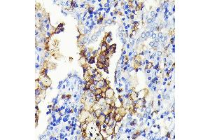 Immunohistochemistry of paraffin-embedded human lung cancer using CD14 Rabbit mAb (ABIN7266167) at dilution of 1:100 (40x lens).