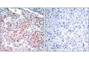 Immunohistochemistry analysis of paraffin-embedded human breast carcinoma, using Estrogen Receptor-alpha (Phospho-Ser104) Antibody. (Estrogen Receptor alpha antibody  (pSer104))