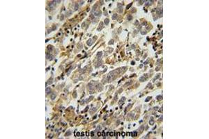 ASB17 Antibody (C-term) immunohistochemistry analysis in formalin fixed and paraffin embedded human testis carcinoma followed by peroxidase conjugation of the secondary antibody and DAB staining. (ASB17 antibody  (C-Term))