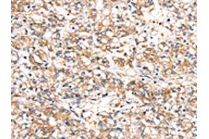 The image on the left is immunohistochemistry of paraffin-embedded Human prostate cancer tissue using ABIN7192435(SLC24A3 Antibody) at dilution 1/20, on the right is treated with synthetic peptide. (SLC24A3 antibody)