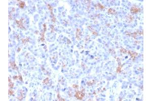 Formalin-fixed, paraffin-embedded human Pancreatic Carcinoma stained with MRP3 Mouse Monoclonal Antibody (ABCC3/2971). (ABCC3 antibody  (AA 815-957))