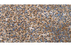 Immunohistochemistry of paraffin-embedded Human liver cancer using UPF1 Polyclonal Antibody at dilution of 1:35 (RENT1/UPF1 antibody)