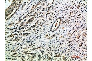 Immunohistochemical analysis of paraffin-embedded human-breast-cancer, antibody was diluted at 1:200 (Integrin alpha 1 antibody  (AA 920-980))