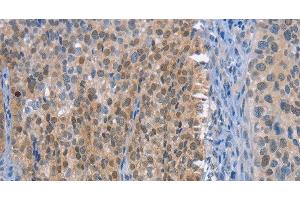 Immunohistochemistry of paraffin-embedded Human cervical cancer tissue using UCK1 Polyclonal Antibody at dilution 1:50 (UCK1 antibody)