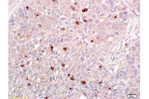 Formalin-fixed and paraffin embedded human lung carcinoma labeled with Anti-ATF2 Polyclonal Antibody, Unconjugated (ABIN669546) at 1:200 followed by conjugation to the secondary antibody and DAB staining. (ATF2 antibody  (AA 188-255))