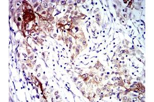 Immunohistochemical analysis of paraffin-embedded esophageal cancer tissues using CD183 mouse mAb with DAB staining.