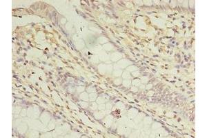 Immunohistochemistry of paraffin-embedded human colon cancer using ABIN7144199 at dilution of 1:100 (ASB8 antibody  (AA 12-288))