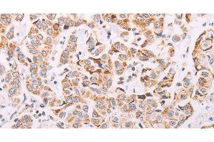 Immunohistochemistry of paraffin-embedded Human breast cancer tissue using ADAMTS16 Polyclonal Antibody at dilution 1:50 (ADAMTS16 antibody)