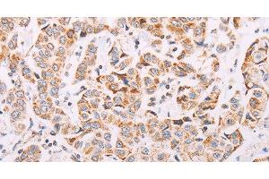 Immunohistochemistry of paraffin-embedded Human breast cancer tissue using ADAMTS16 Polyclonal Antibody at dilution 1:50