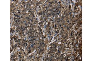 Immunohistochemistry of Human liver cancer using GSTA3 Polyclonal Antibody at dilution of 1:30