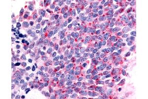 Anti-OR6K3 antibody IHC of human Lung, Small Cell Carcinoma. (OR6K3 antibody  (C-Term))