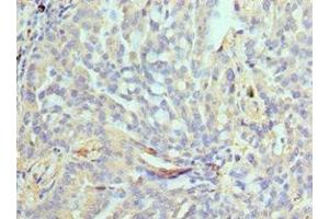 Immunohistochemistry of paraffin-embedded human lung cancer using ABIN7161635 at dilution of 1:100 (NPRL2 antibody  (AA 1-220))