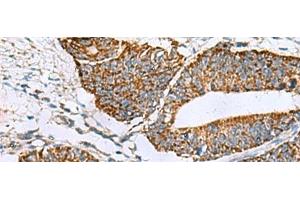 Immunohistochemistry of paraffin-embedded Human colorectal cancer tissue using PRELID3B Polyclonal Antibody at dilution of 1:90(x200) (SLMO2 antibody)