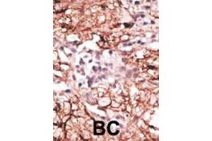 Formalin-fixed and paraffin-embedded human cancer tissue reacted with the primary antibody, which was peroxidase-conjugated to the secondary antibody, followed by DAB staining. (LSD1 antibody  (N-Term))