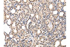 The image on the left is immunohistochemistry of paraffin-embedded Human thyroid cancer tissue using ABIN7127989(PPIL1 Antibody) at dilution 1/30, on the right is treated with fusion protein. (PPIL1 antibody)