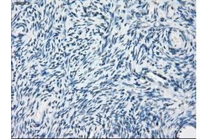 Immunohistochemical staining of paraffin-embedded Adenocarcinoma of breast tissue using anti-PDE10A mouse monoclonal antibody. (PDE10A antibody)