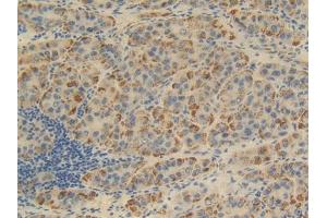 DAB staining on IHC-P; Samples: Human Liver cancer Tissue (FKBP1B antibody  (AA 2-108))