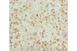 Immunohistochemistry of paraffin-embedded human glioma using ABIN7160986 at dilution of 1:100 (NDUFS1 antibody  (AA 80-290))