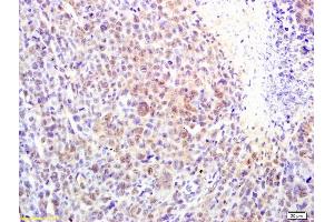 Formalin-fixed and paraffin embedded mouse lymphoma labeled with Rabbit Anti alpha MSH Polyclonal Antibody, Unconjugated (ABIN735323) at 1:200 followed by conjugation to the secondary antibody and DAB staining (MSH alpha (AA 138-150) antibody)