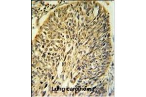 FKBP9 Antibody (C-term) (ABIN391581 and ABIN2841515) IHC analysis in formalin fixed and paraffin embedded human Lung carcinoma followed by peroxidase conjugation of the secondary antibody and DAB staining. (FKBP9 antibody  (C-Term))