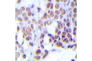 Immunohistochemical analysis of MGMT staining in human prostate cancer formalin fixed paraffin embedded tissue section.