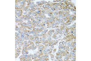 Immunohistochemistry of paraffin-embedded human liver cancer using NDUFA2 antibody. (NDUFA2 antibody)