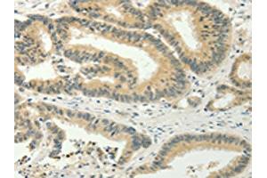 The image on the left is immunohistochemistry of paraffin-embedded Human colon cancer tissue using ABIN7128020(SPIN4 Antibody) at dilution 1/20, on the right is treated with fusion protein. (SPIN4 antibody)
