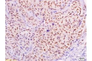 Formalin-fixed and paraffin embedded transplanted tumor of cervical carcinoma in nude mice labeled with Anti-MTA1 Polyclonal Antibody, Unconjugated (ABIN686182) at 1:300, followed by conjugation to the secondary antibody and DAB staining (MTA1 antibody  (AA 601-715))