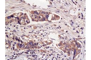 Formalin-fixed and paraffin embedded human endometrial carcinoma labeled with Anti- Hpt/Haptoglobin Polyclonal Antibody, Unconjugated (ABIN734738) at 1:200 followed by conjugation to the secondary antibody and DAB staining