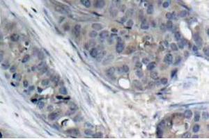 Immunohistochemistry (IHC) analyzes of p-IRS-1 antibody in paraffin-embedded human breast carcinoma tissue. (IRS1 antibody  (pSer307))