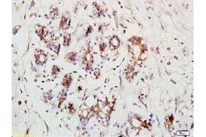 Formalin-fixed and paraffin embedded human breast carcinoma labeled with Anti- RPS3 Polyclonal Antibody, Unconjugated (ABIN872550) at 1:200 followed by conjugation to the secondary antibody