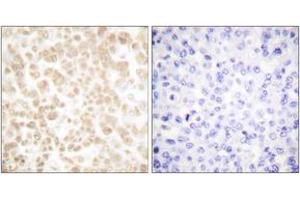 Immunohistochemistry analysis of paraffin-embedded human breast carcinoma tissue, using Fra-2 Antibody. (FOSL2 antibody  (AA 271-320))