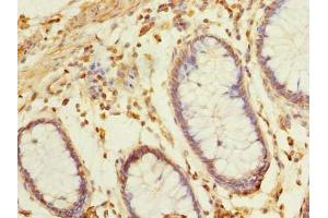 Immunohistochemistry of paraffin-embedded human colon cancer using ABIN7145650 at dilution of 1:100 (BRINP2 antibody  (AA 34-300))