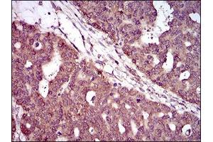 Immunohistochemical analysis of paraffin-embedded ovarian cancer tissues using PIWIL4 mouse mAb with DAB staining. (PIWIL4 antibody  (AA 304-434))