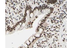 ABIN6267567 at 1/200 staining human colon cancer tissue sections by IHC-P. (Histone H3.1 antibody  (pSer10))