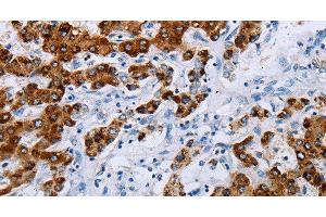 Immunohistochemistry of paraffin-embedded Human liver cancer tissue using NDUFA12 Polyclonal Antibody at dilution 1:50 (NDUFA12 antibody)