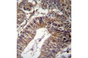 Immunohistochemistry analysis in formalin fixed and paraffin embedded human colon carcinoma reacted with GCC1 Antibody (C-term) followed by peroxidase conjugation of the secondary antibody and DAB staining.