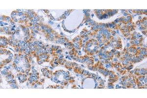 Immunohistochemistry of paraffin-embedded Human thyroid cancer using KIF3A Polyclonal Antibody at dilution of 1:40
