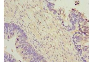 Immunohistochemistry of paraffin-embedded human ovarian cancer using ABIN7166313 at dilution of 1:100 (WNT7B antibody  (AA 120-349))