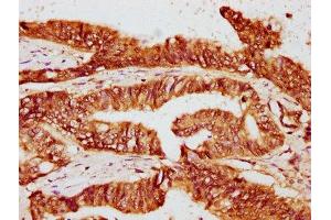 IHC image of ABIN7162837 diluted at 1:400 and staining in paraffin-embedded human colon cancer performed on a Leica BondTM system. (FKBP4 antibody  (AA 1-240))