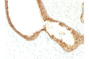 Formalin-fixed, paraffin-embedded human Prostate Carcinoma stained with E-Cadherin MAb (CDH1/1525).