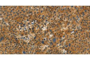 Immunohistochemistry of paraffin-embedded Human liver cancer tissue using NPAP1 Polyclonal Antibody at dilution 1:60 (NPAP1 antibody)