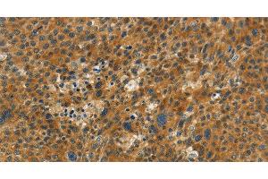 Immunohistochemistry of paraffin-embedded Human liver cancer tissue using NPAP1 Polyclonal Antibody at dilution 1:60