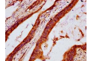 IHC image of ABIN7142854 diluted at 1:600 and staining in paraffin-embedded human colon cancer performed on a Leica BondTM system. (DHCR7 antibody  (AA 63-147))