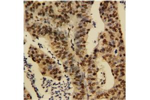 Immunohistochemical staining of Human rectal cancer (TNFAIP1 antibody  (N-Term))