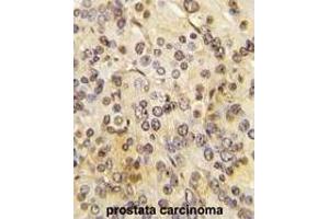Formalin-fixed and paraffin-embedded human prostata carcinoma tissue reacted with MEN1 Antibody  (ABIN391614 and ABIN2841535) , which was peroxidase-conjugated to the secondary antibody, followed by DAB staining. (Menin antibody  (AA 584-615))