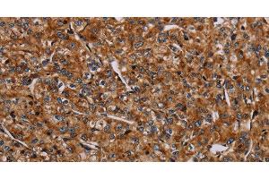 Immunohistochemistry of paraffin-embedded Human prostate cancer using NDUFA8 Polyclonal Antibody at dilution of 1:40 (NDUFA8 antibody)